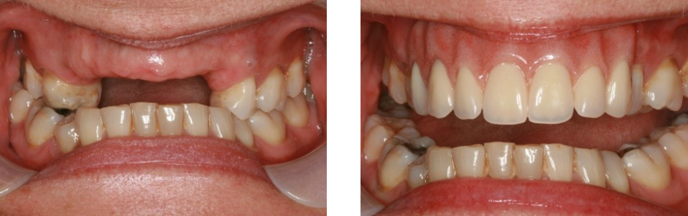  dental bridge front teeth cost uk